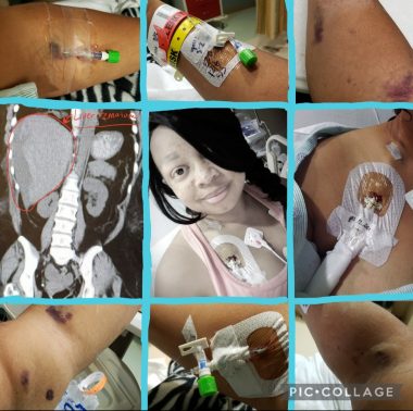 A collage features nine photos from a woman's hospitalization. At the center is a photo of Shalana, who is smiling, wearing a pink tank top, and has several IVs and monitors connected to her chest. One photo depicts a scan of her organs, and the other photos show various scars, ports, and IVs.