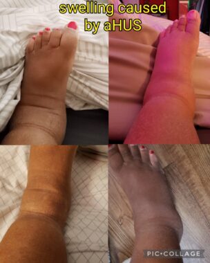 A four-photo collage shows a single, swollen foot in each frame. Yellow text at the top states, "swelling caused by aHUS." 
