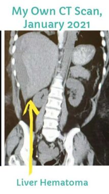 A CT scan shows a large liver hematoma.