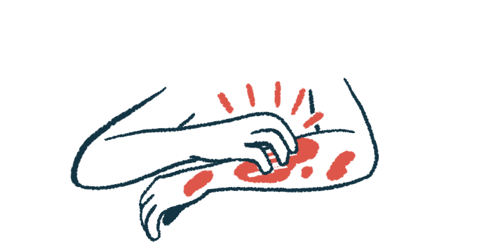 A person scratches an arm with red spots on it.